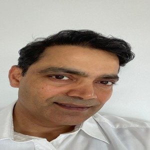 Microscopic FUE Hair Transplant — before