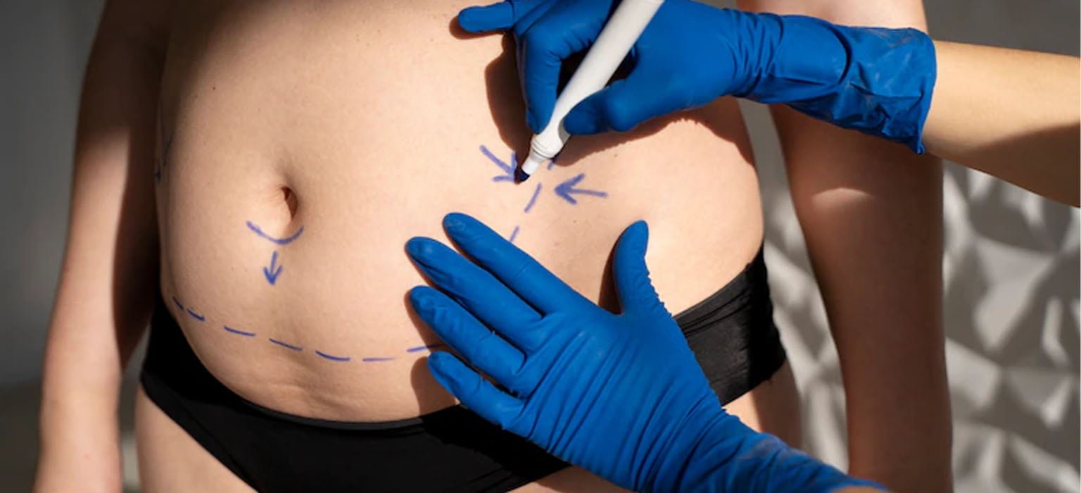 High-Definition Liposuction — before