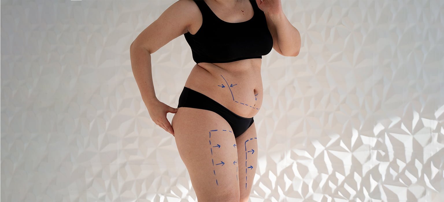 Abdominoplasty (Tummy Tuck) — before